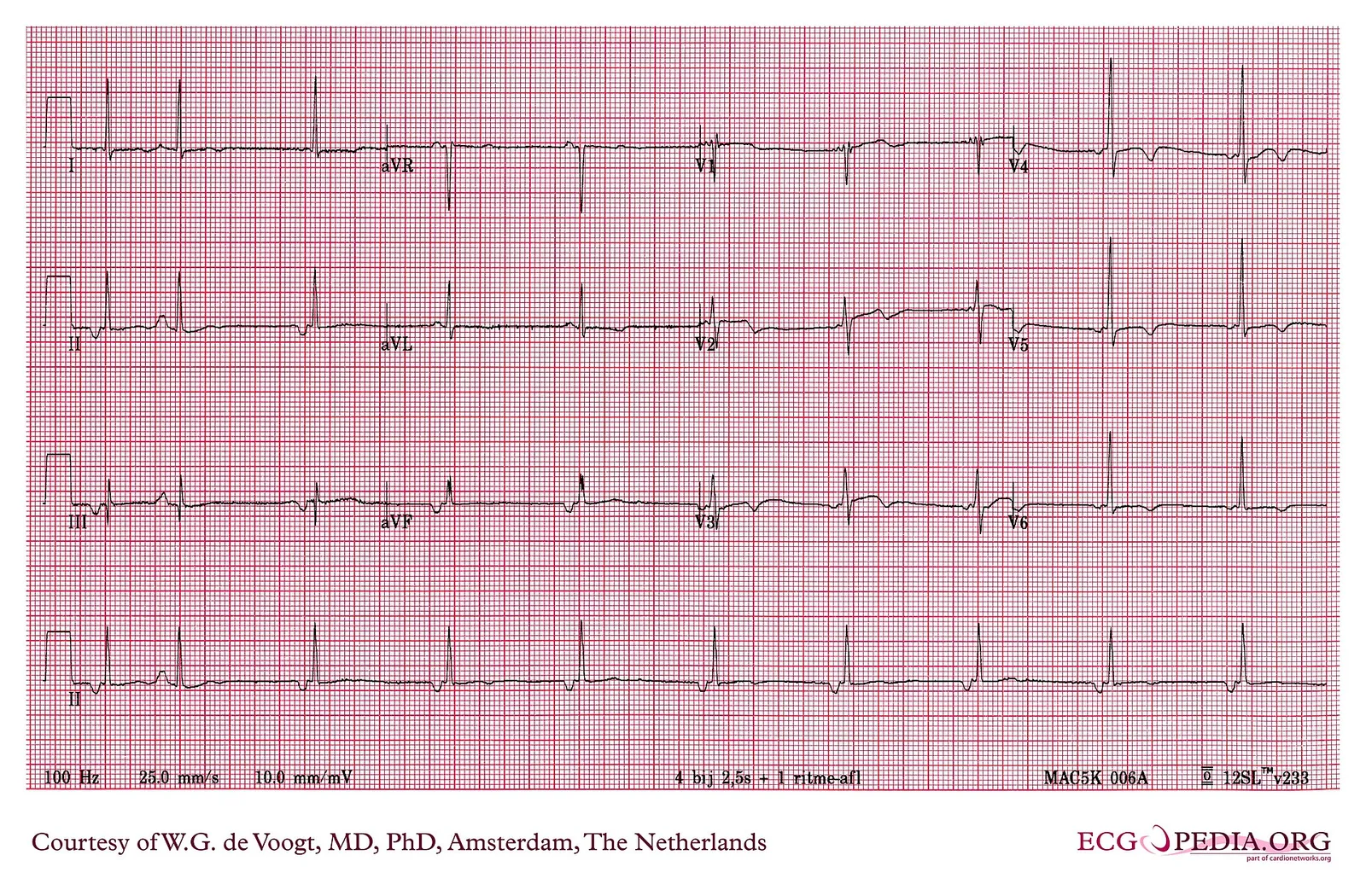 Zapis elektrokardiogramu (EKG)